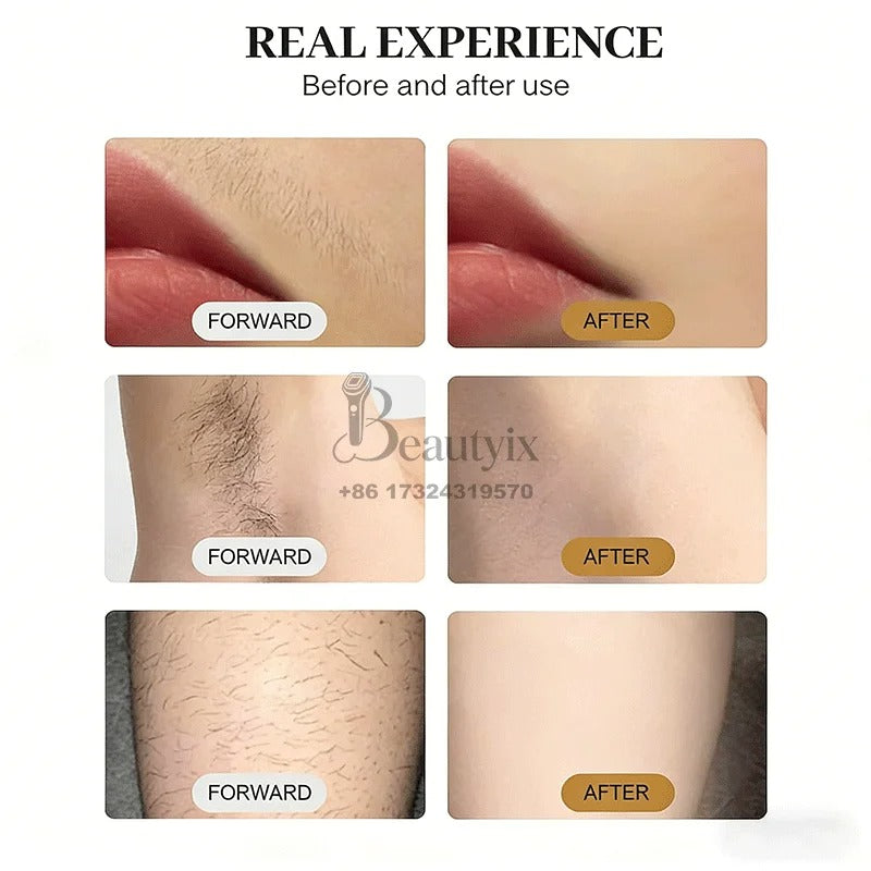 4-Wavelength 4000W 755nm 808nm 940nm 1064nm Alexandrite Diode Laser Painless Permanent Hair Removal Depilation Equipment
